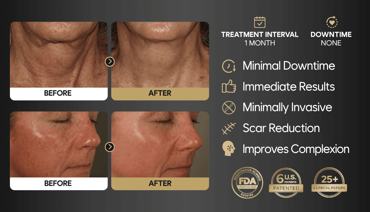 SylfirmX RF Microneedling