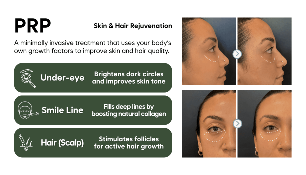 PRP (Under-eye / Smile Line / Hair)